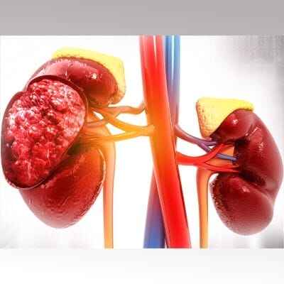 ayurvedic kidney treatment