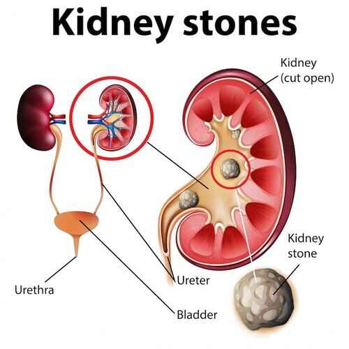 lemon water for kidney stone