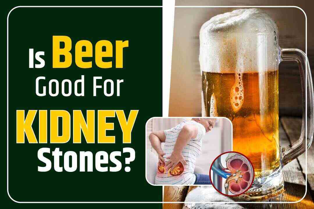 Is Beer Good For Kidney Stones?