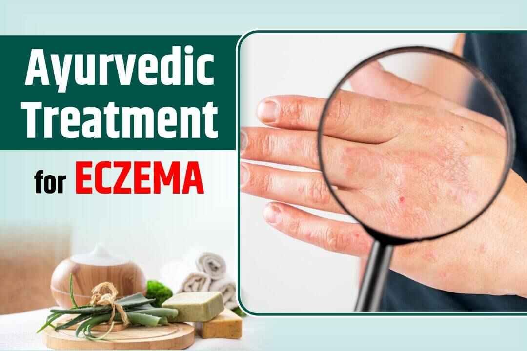 Ayurvedic Treatment for Eczema | Eczema Ayurvedic Treatment